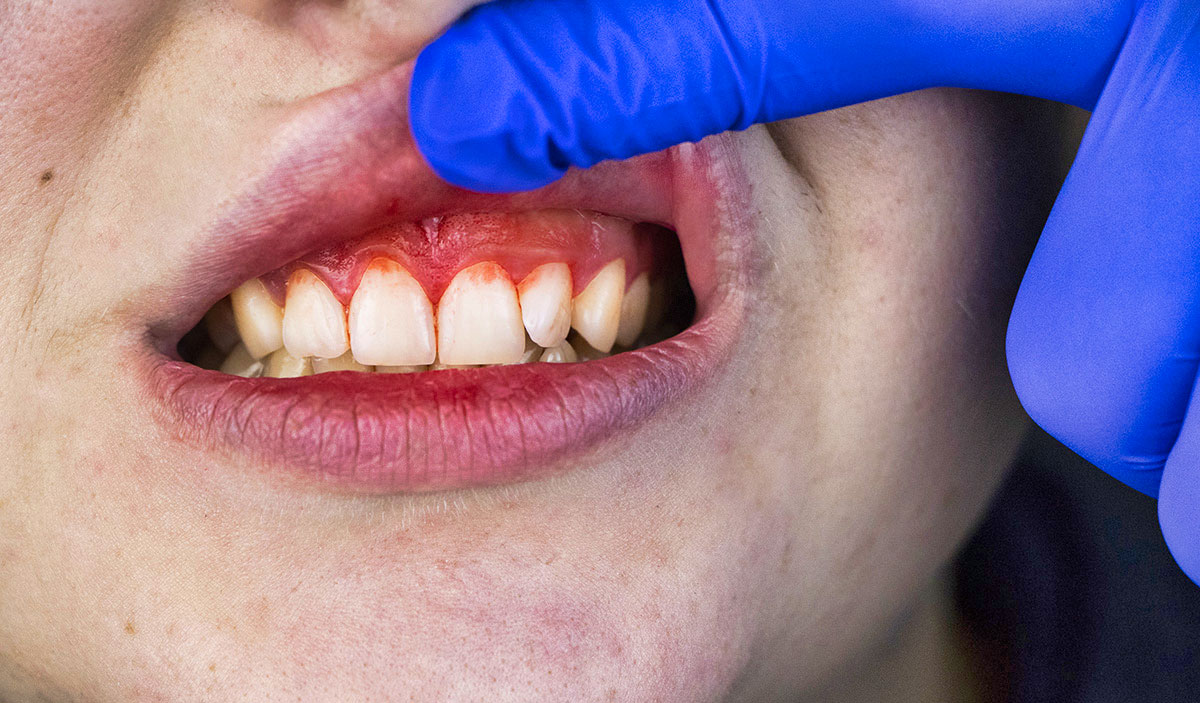 Common Causes for Bleeding Gums & Treatment